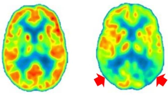 הדמייה המשווה מוח במצב "רגיל" (משמאל) למוח במצב נסיגה קוגניטיבית (מימין). החלקים האדומים הם הגלוקוז במוח. מתוך מצגת של פרופ' סטפן ס' קונאן.