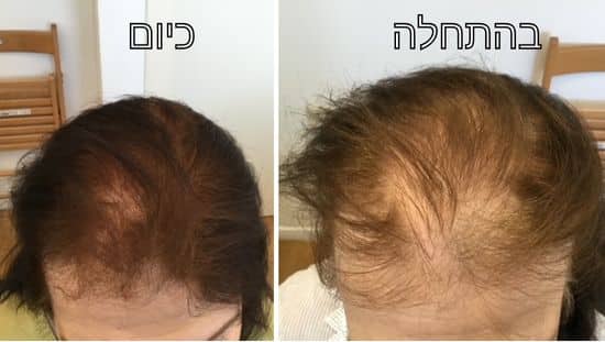 לפני... ואחרי. צילום: אלבום פרטי