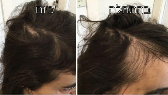 בהתחלה ואחרי חצי שנה של טיפול. צילום: אלבום פרטי