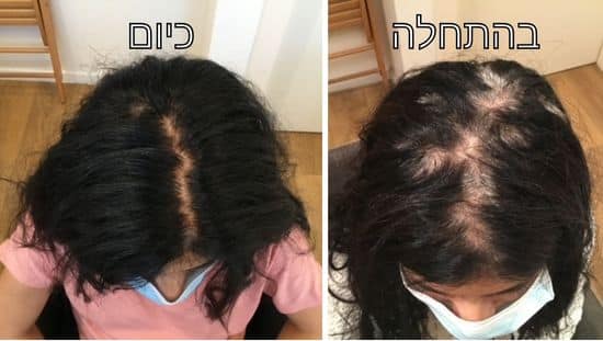 בתחילתו של התהליך וכיום. צילום: אלבום פרטי